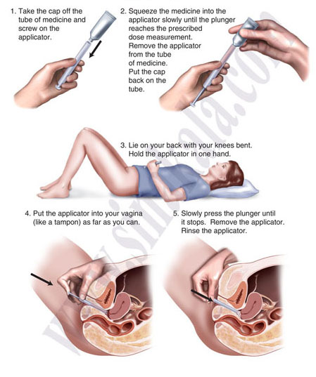 How to apply vaginal applicators