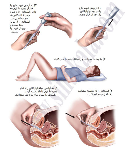 How to apply vaginal applicators طریقه مصرف اپلیکاتور کرم و ژل واژینال